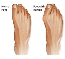 Bunions & Foot Problems - What is a Bunion